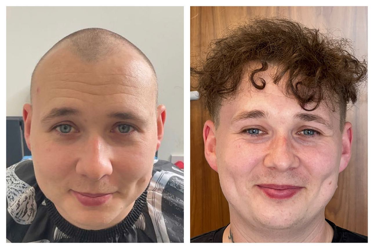B&A hair transplant temporal point - Patient 5