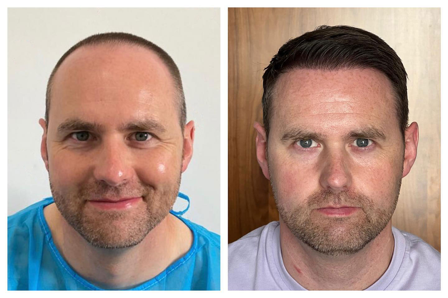 B&A hair transplant temporal point - Patient 1