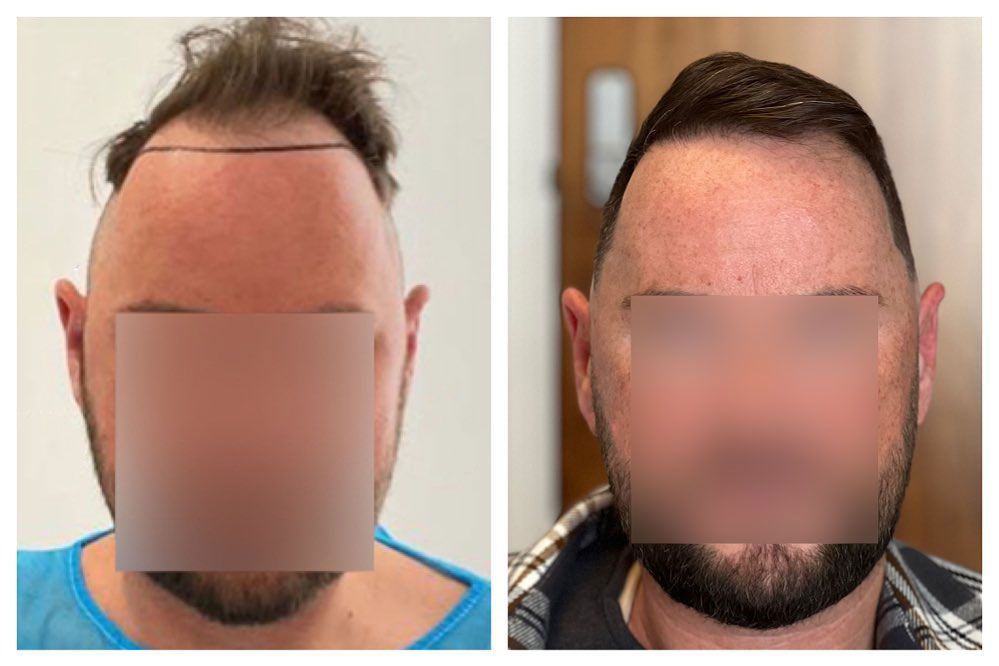 B&A hair transplant temporal point - Patient 4