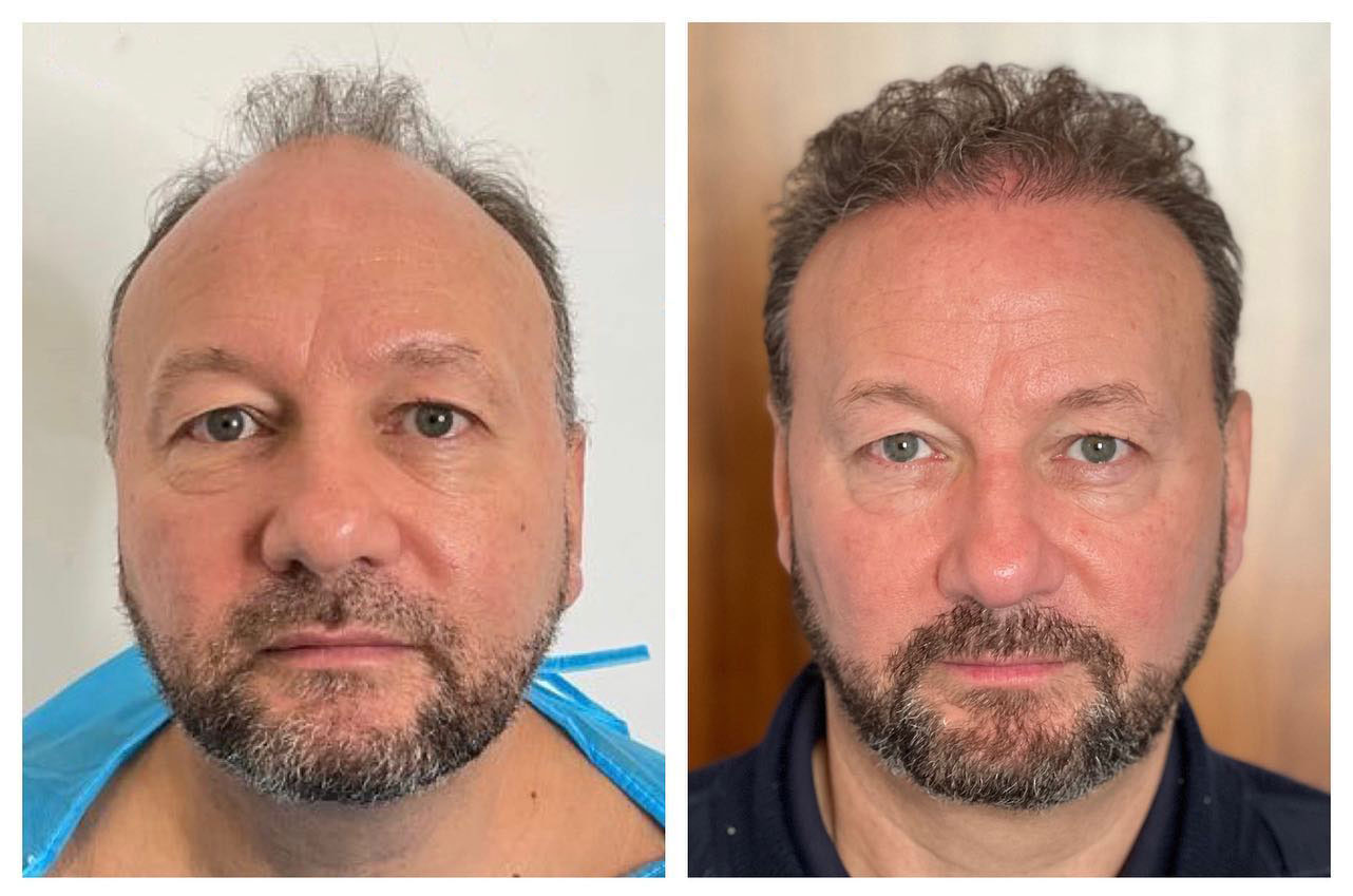 B&A hair transplant temporal point - Patient 3