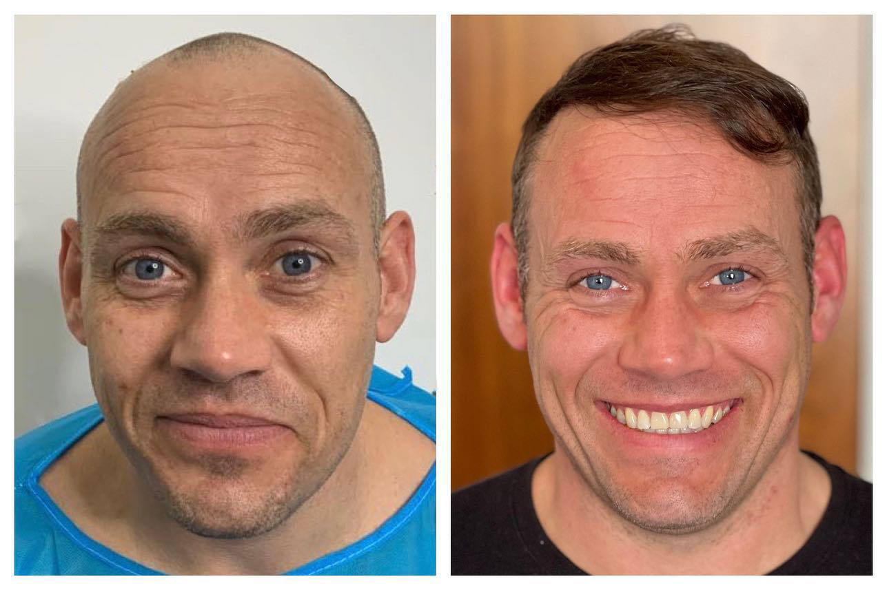 B&A hair transplant temporal point - Patient 2